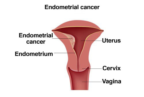 endometrial-cancer